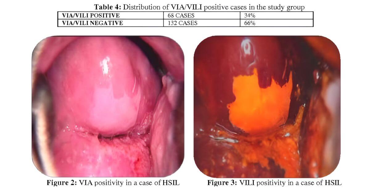 Các tổn thương cổ tử cung khi quan sát bằng phương pháp VIA (trái) và VILI (phải)