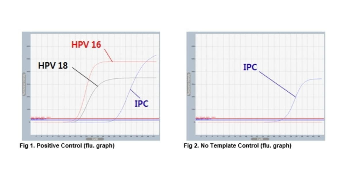 Kết quả realtime PCR phát hiện và định tuýp HPV. Kết quả dương tính (trái) và âm tính (phải)