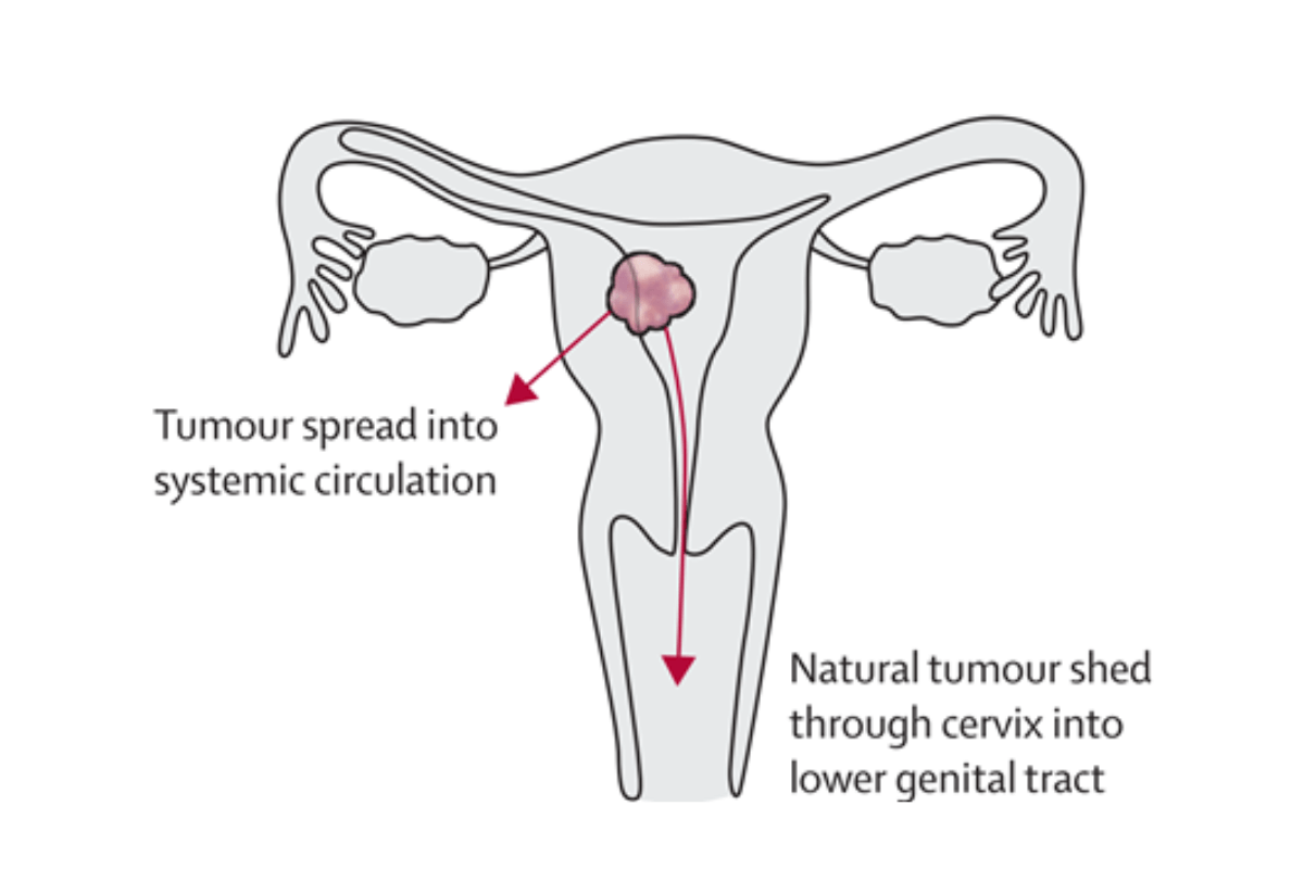 Tế bào khối u nội mạc tử cung có thể được tìm thấy trong máu và ở vùng cổ tử cung trong tự nhiên