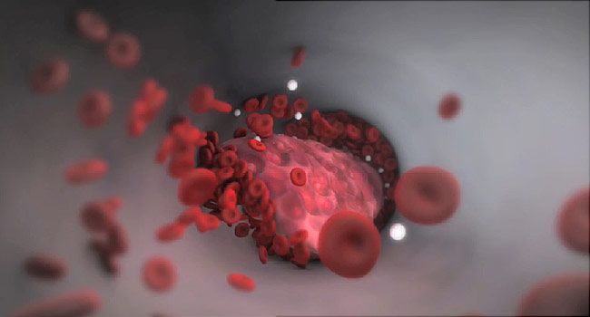 Thrombophilia: Huyết khối tĩnh mạch di truyền